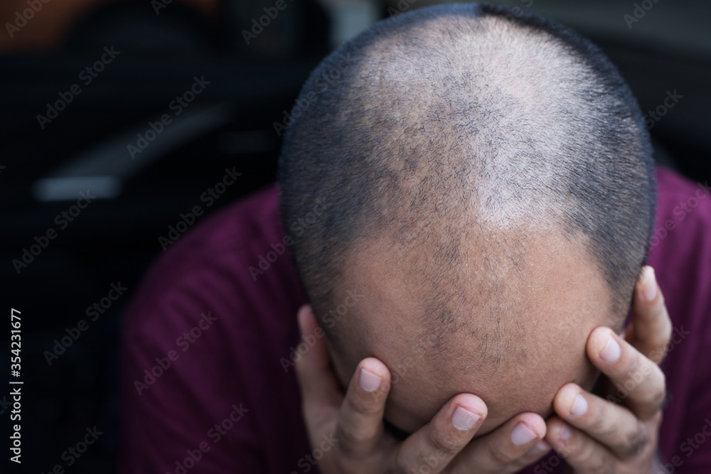 Close up man head of hair loss