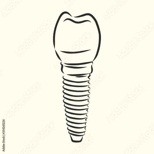 Vector illustration. sketches, dental implants. dental implant, vector sketch illustration