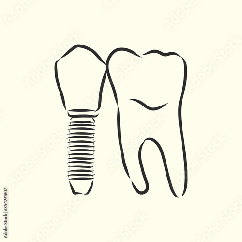 Vector illustration. sketches, dental implants. dental implant, vector sketch illustration