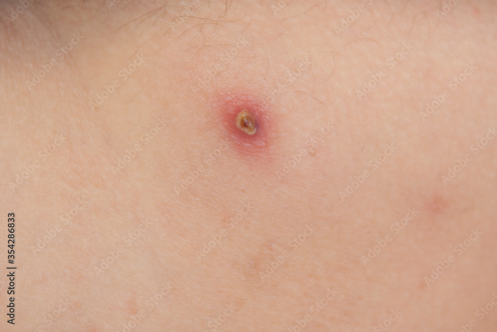 Big red boiling pimple furuncle on the skin, inflamed boil, dermatology photo Big red boiling pimple furuncle on the skin, inflamed boil, dermatology photo