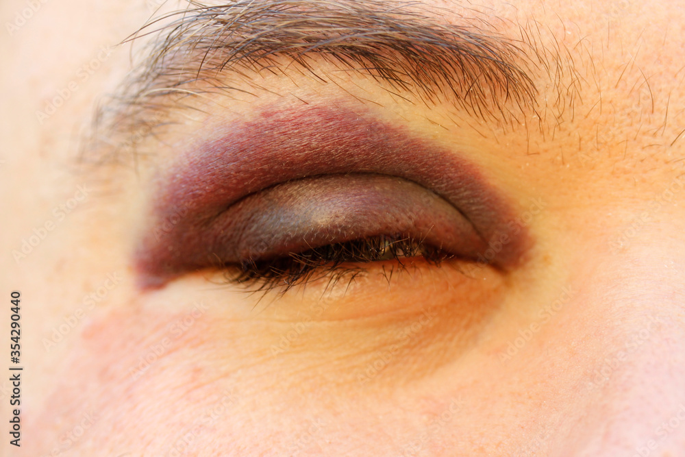 Obraz premium Black eye.