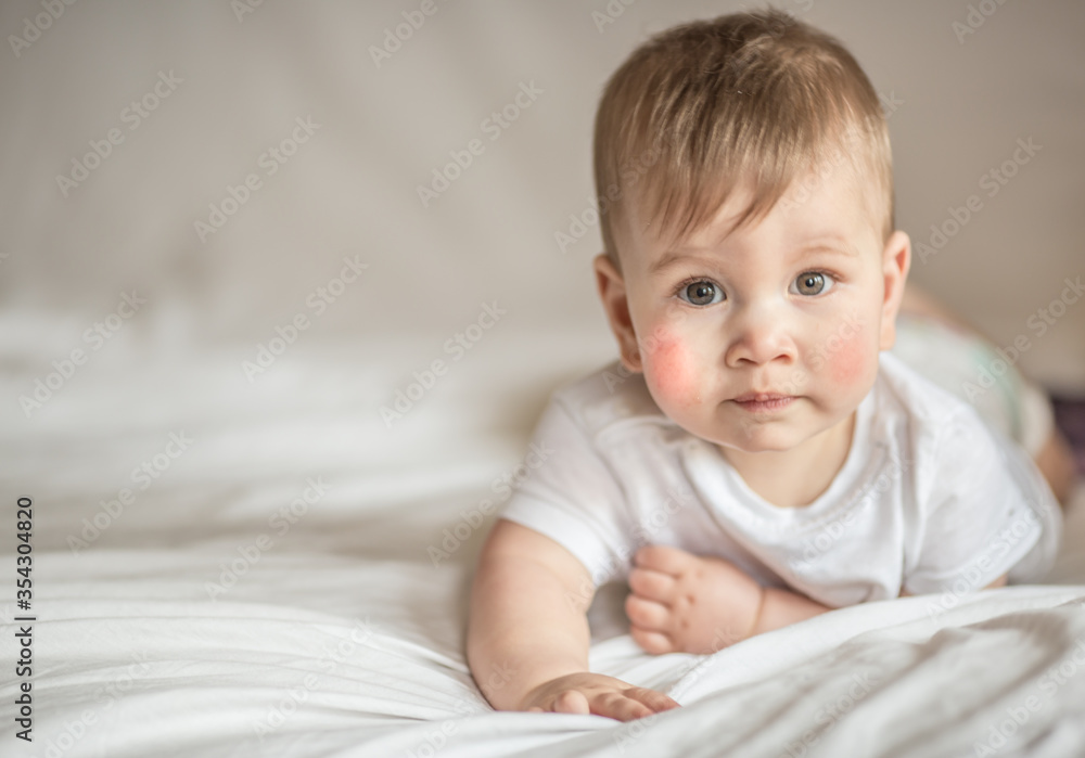Atopic dermatitis eczema in baby.Condition that causes the skin to become red,dry,sore,itchy and cracked.Atopic eczema most often affects face in children. London England UK,Mart 30 2020 Atopic dermatitis eczema in baby.Condition that causes the skin to become red,dry,sore,itchy and cracked.Atopic eczema most often affects face in children. London England UK,Mart 30 2020