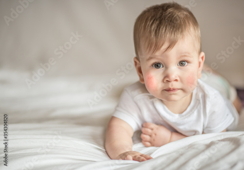Atopic dermatitis eczema in baby.Condition that causes the skin to become red,dry,sore,itchy and cracked.Atopic eczema most often affects face in children. London England UK,Mart 30 2020 photo