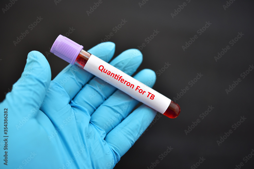 Obraz premium Test tube with blood sample for Quantiferon test, diagnosis for mycobacterium tuberculosis infection