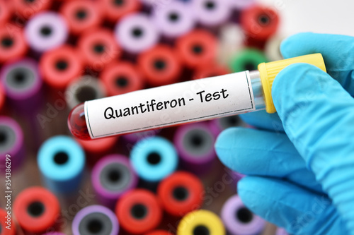 Test tube with blood sample for Quantiferon test, diagnosis for mycobacterium tuberculosis infection photo