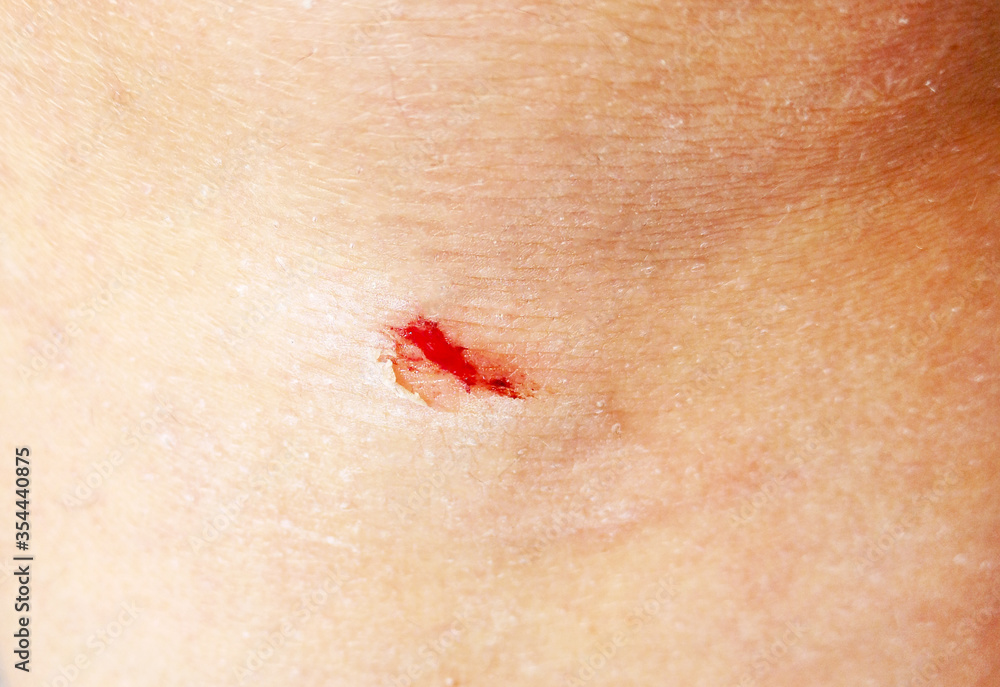 Fototapeta premium Small wound on the knee