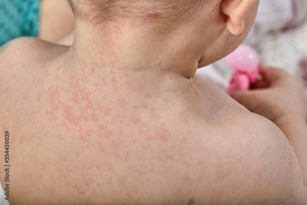 roseola rash a viral rash on the skin of a child roseola rash a viral rash on the skin of a child