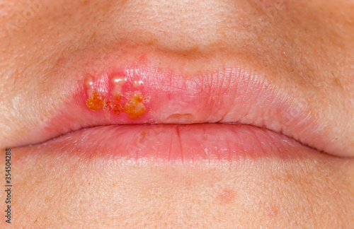 Cuadro en lienzo Oral herpes simplex virus infection