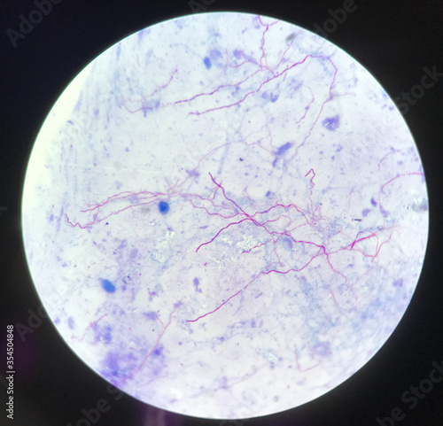 Red branching mycobacterium tuberculosis on blue background in modified acid fast bacilli stain.