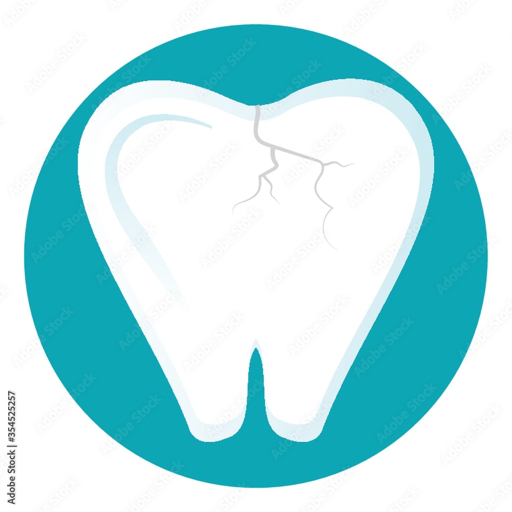 Cracked tooth Cracked tooth