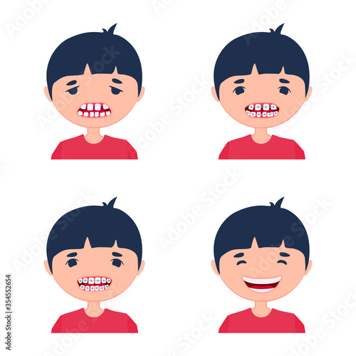 A kid before and after using dental aligner braces. Corrective treatment of a child. A process of crooked teeth alignment. Little boy being sad and happily smiling.