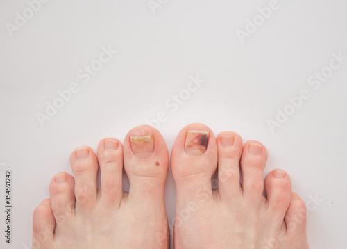 Nail figure, ingrown nail, onychocryptosis. toenail clamp on an ingrown toenail