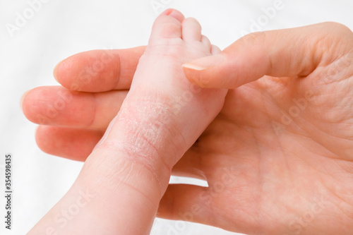 Young woman hand holding infant leg. Red dry skin allergy from milk formula or other food. Closeup.