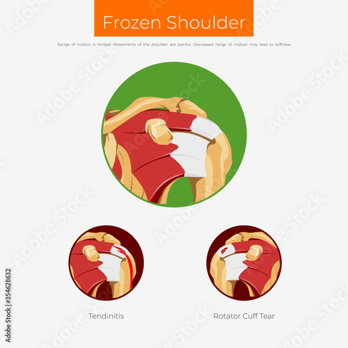 Frozen shoulder anatomy scheme poster