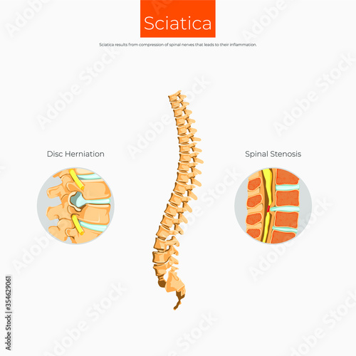 Sciatica results from compression of spinal nerves.