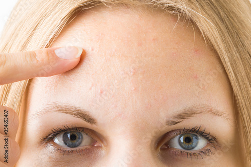 Young woman finger pointing to small pimples. Rash on forehead skin. Closeup. photo