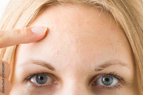 Young woman finger pointing to small pimples. Rash on forehead skin. Closeup.