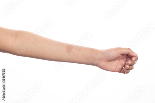 Oil burn platter on skin isolated in white background