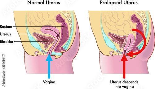 Medical illustration showing the difference between a normal uterus and a prolapsed uterus with annotations explaining how this occurs.