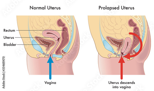 Medical illustration showing the difference between a normal uterus and a prolapsed uterus with annotations explaining how this occurs. photo