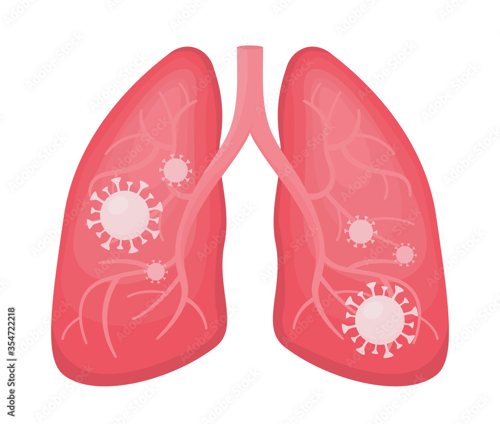Flat vector illustration of human lungs infected with coronavirus or viral pneumonia and covid. Pandemic impact on your health, virus cells, detail outline of anatomy organ isolated. Flat vector illustration of human lungs infected with coronavirus or viral pneumonia and covid. Pandemic impact on your health, virus cells, detail outline of anatomy organ isolated.