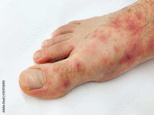 Close up of male's foot and toes with red rash desease on a white background.