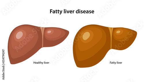 Obesity of liver. Fatty liver disease. Healthy and fatty liver in flat style. Medical vector illustration isolated over white background.