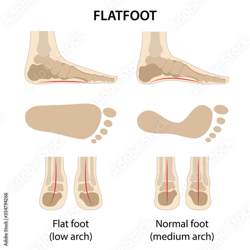Orthopedics. Flatfoot. Difference between sick and healthy feet. Side view, footprints and back view. Vector illustration in flat style isolated on white background.