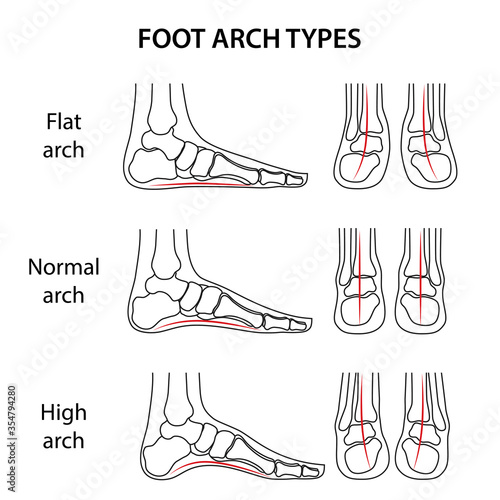 Orthopedics. Foot arch types. Flatfoot. Difference between sick and healthy feet. Vector illustration in outline style isolated on white background.