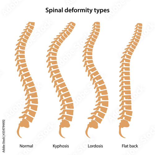 Spinal deformity types. Lateral view of human spines. Medical vector illustration in flat style is isolated on white background