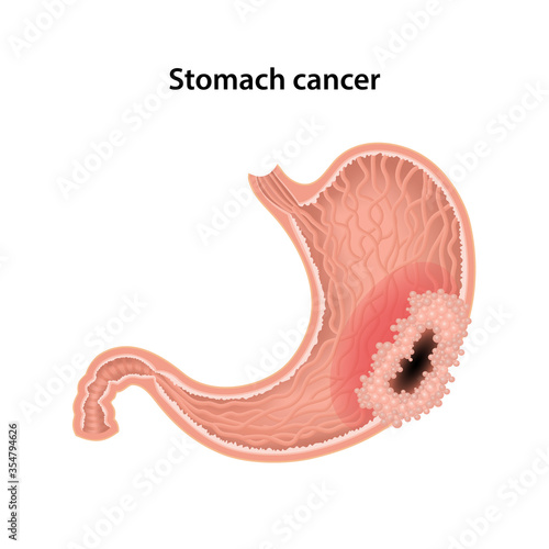 Stomach cancer. Anatomical vector illustration of the stomach cancer isolated over white background.