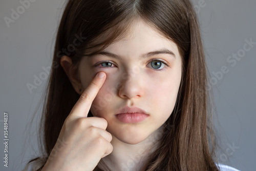 a little girl has an eye pain, eye injury, conjunctivitis, allergies, a child has swollen eyes