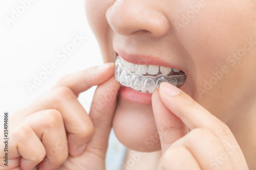 Woman wearing orthodontic silicone trainer. Mobile orthodontic appliance for dental correction. tooth whitening systems.