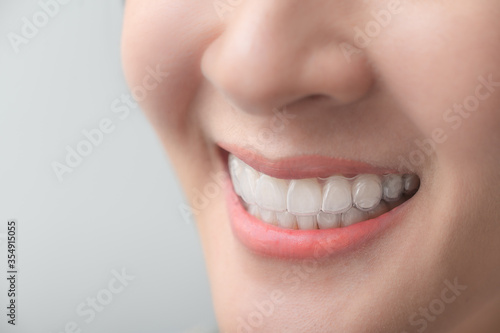 Woman wearing orthodontic silicone trainer. Mobile orthodontic appliance for dental correction. tooth whitening systems.