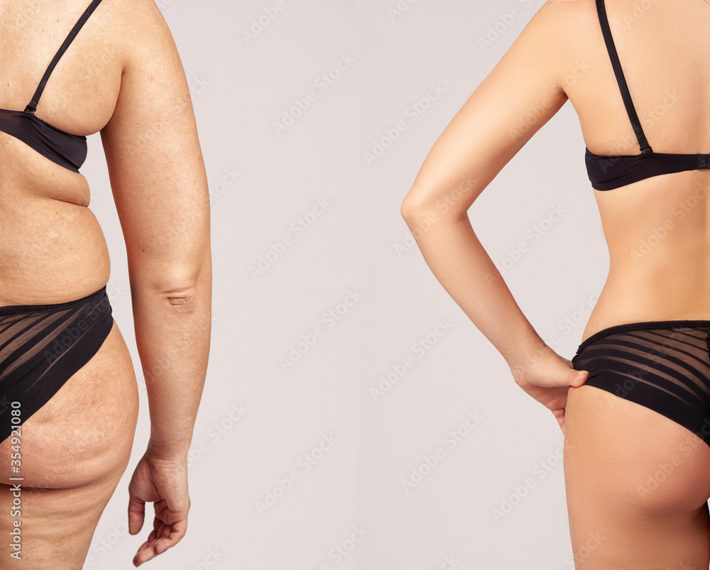 Comparison of women before and after weight loss. Diet and healthy nutrition. Liposuction results. - obrazy, fototapety, plakaty 