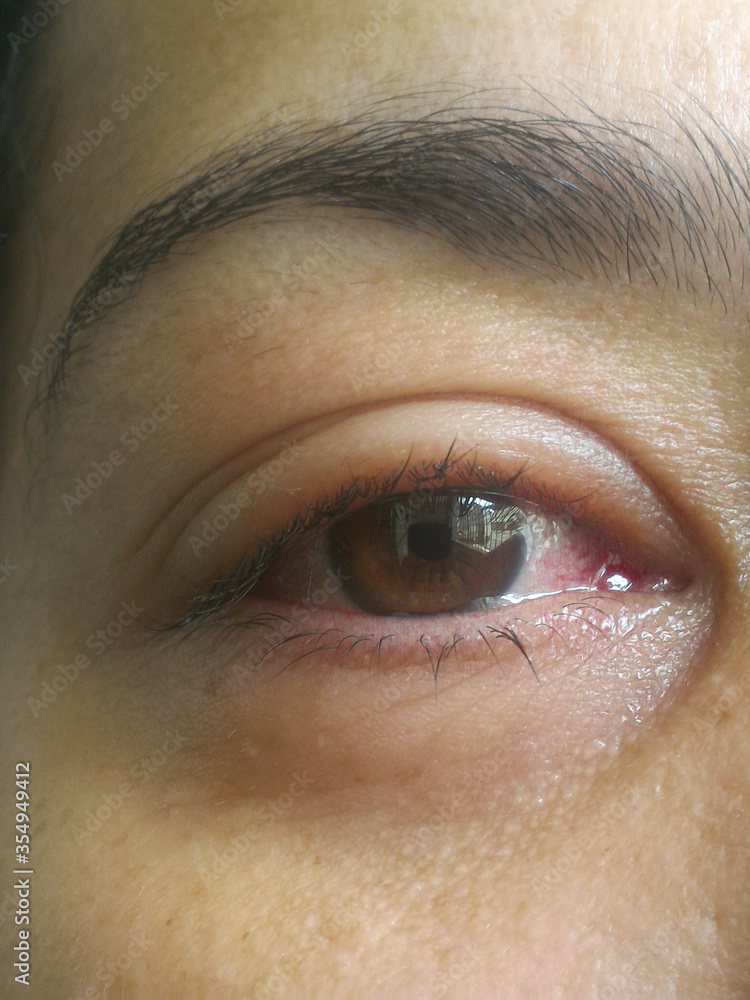 Fototapeta premium Close up one annoyed red blood female right eye, swollen eye affected by conjunctivitis or after flu, cold or allergy. Concept of disease and treatment.