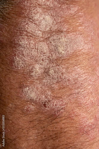 Slika na platnu Psoriasis is a Chronic, inflammatory autoinmune skin disease
