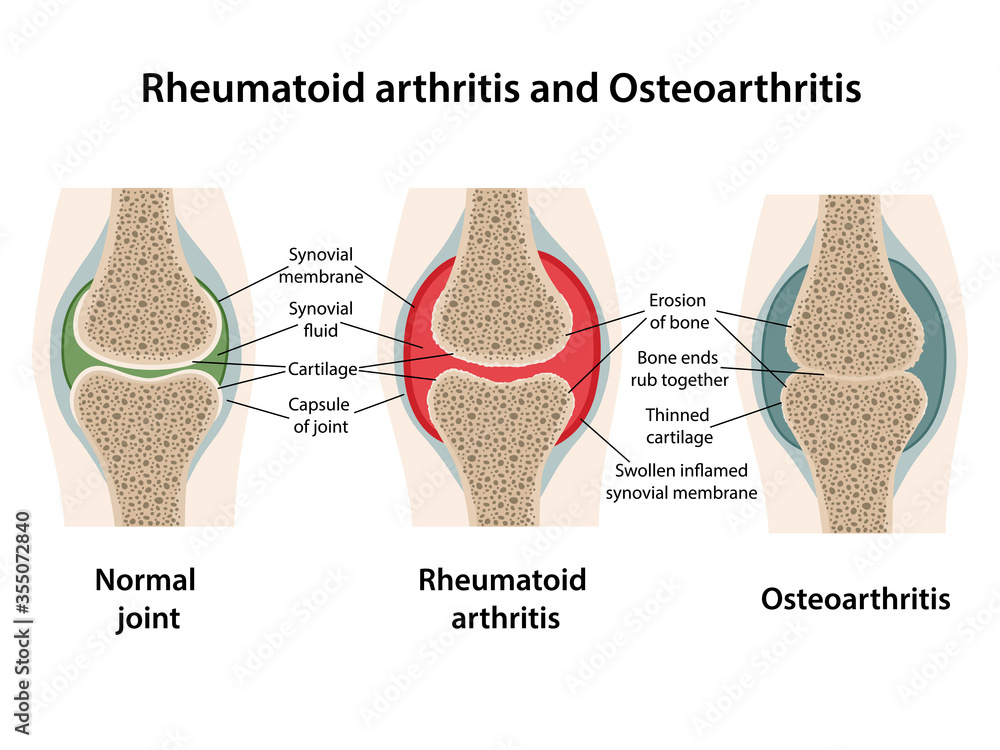 Rheumatoid arthritis and osteoarthritis of the joint. Image of healthy ...
