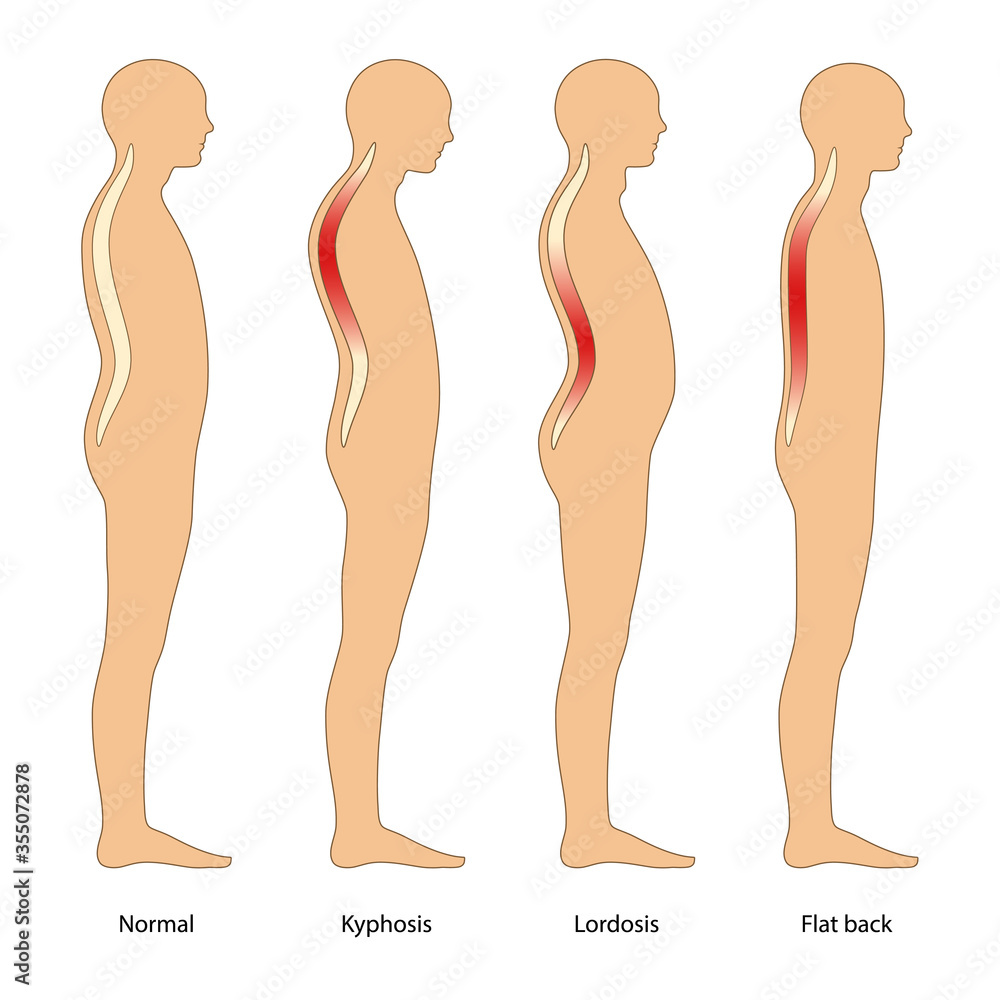 Spinal deformity types. Lateral view of human body. Medical vector  illustration in flat style is isolated on white background Stock Vector |  Adobe Stock