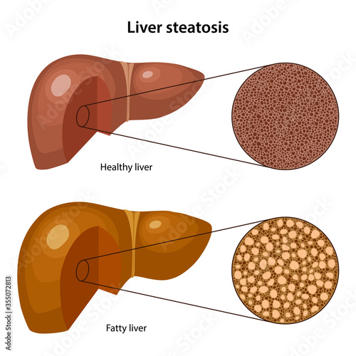 Liver steatosis. Histology of the healthy and fatty liver with corresponding labels. Anatomical vector illustration in flat style isolated over white background.