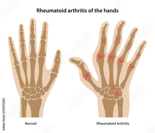Rheumatoid arthritis of the human's hands. Silhouettes of healthy and sore hands isolated on white background. Medical vector illustration