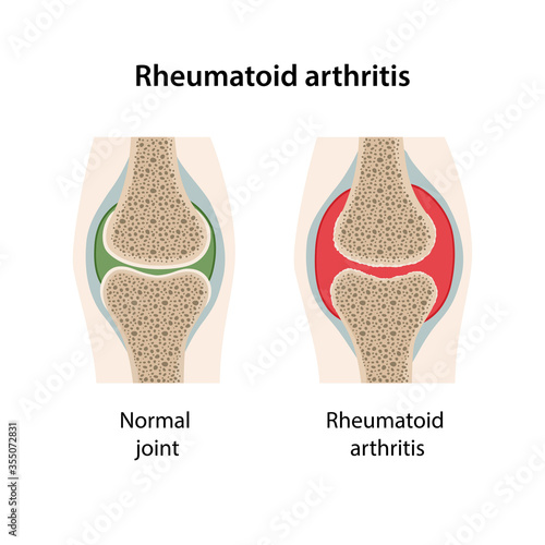 Rheumatoid arthritis of the joint. Image of healthy joint and diseased joint. Medical vector illustration in flat style isolated on white background