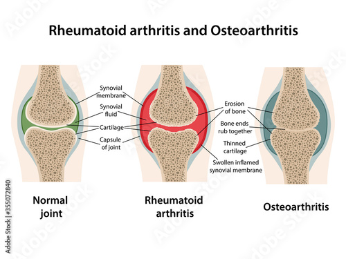 Rheumatoid arthritis and osteoarthritis of the joint. Image of healthy joint and diseased joints with main parts labeled. Vector illustration in flat style isolated on white background