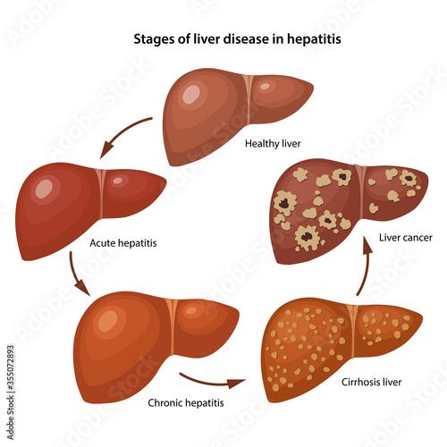 Stages of liver disease in hepatitis with description corresponding steps: healthy, acute, chronic hepatitis, cirrhosis and cancer liver. Vector illustration in flat style on white background.