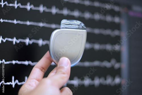 This image demonstrates Implantable cardioverter defibrillator (ICDs) on hands photo