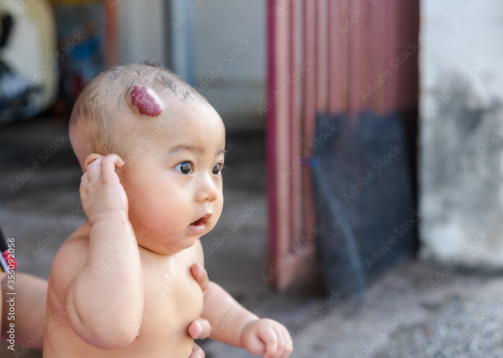 An adorable little child girl with big capillary strawberry hemangiomas red  birthmark on the head is