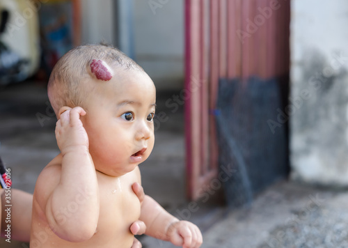 An adorable little child girl with big capillary strawberry hemangiomas red birthmark on the head is bathing at home with mother in summer. Concept of care child and health care of baby skin. photo