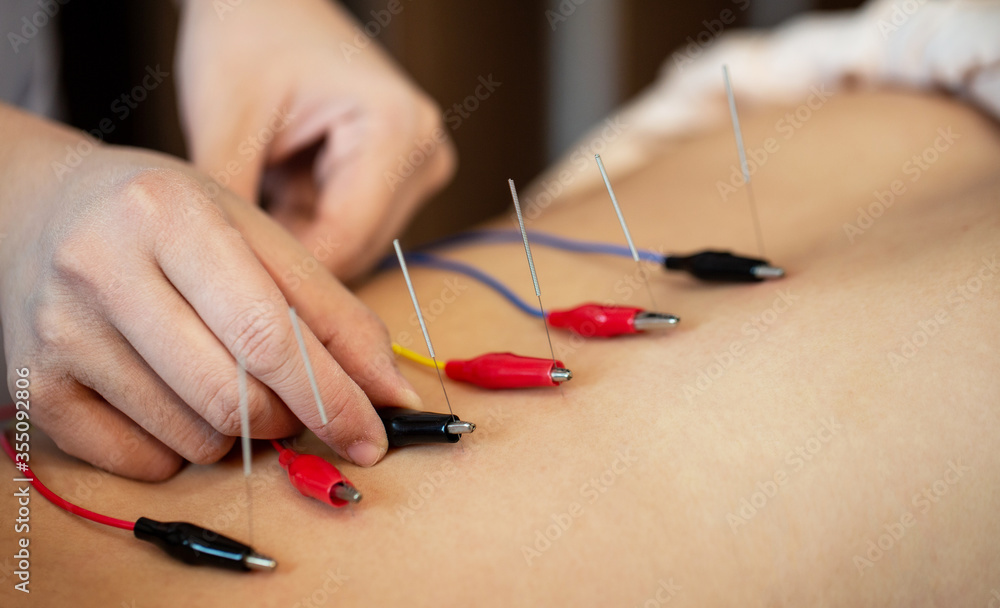 Electro-Acupuncture.Traditional Chinese acupuncture and Electro acupuncture on body of patient Electro-Acupuncture.Traditional Chinese acupuncture and Electro acupuncture on body of patient