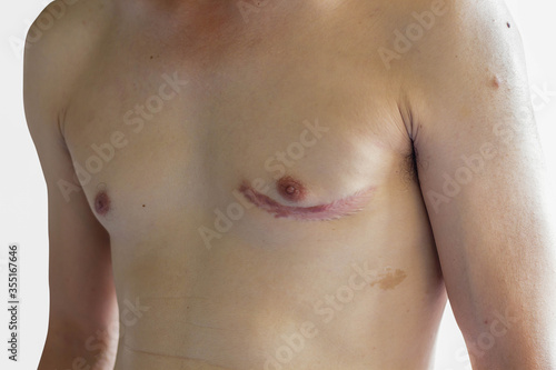 Scar around the breast of man after surgery on white background