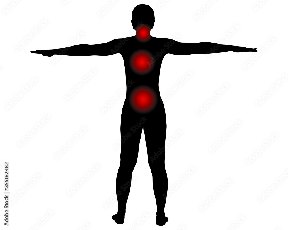 Rückansicht Frau mit Symbol für Schmerzen im Rücken